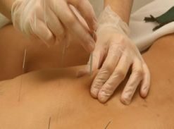 Acupuntura Terapêutica